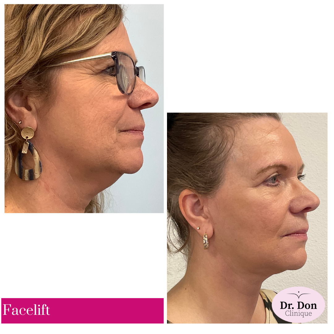 Facelift incl. uitgebreide halslift en bovenooglidcorrectie